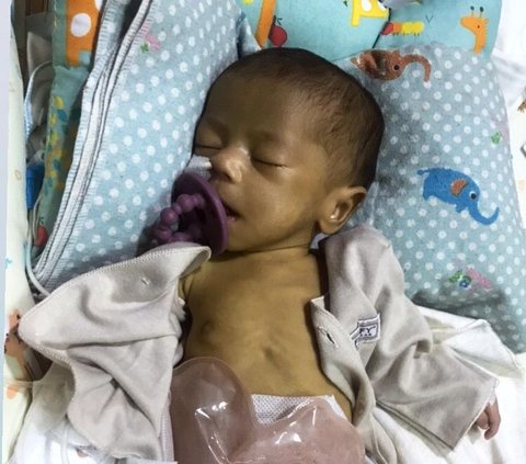 Suster Salah Kasih Susu, Bayi Dua Bulan Kritis Hingga Gizi Buruk