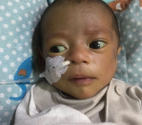 Suster Salah Kasih Susu, Bayi Dua Bulan Kritis Hingga Gizi Buruk