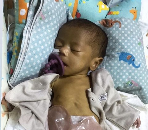 Suster Salah Kasih Susu, Bayi Dua Bulan Kritis Hingga Gizi Buruk