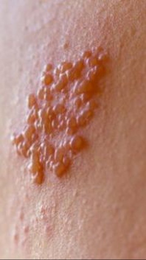 Waspadai Penyebab Penyakit Herpes Kulit, Bisa Menular Melalui Kontak Kulit