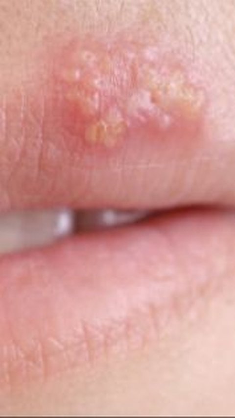 Waspadai Penyebab Penyakit Herpes Kulit, Bisa Menular Melalui Kontak Kulit