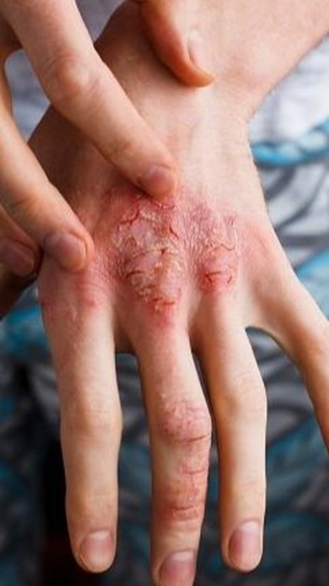 Gejala Penyakit Dermatitis