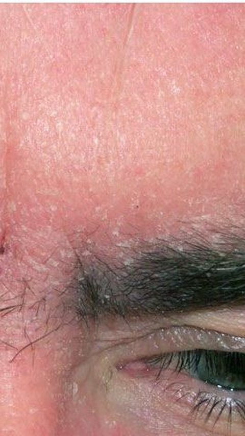 Cara Mengobati Dermatitis