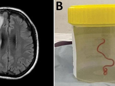 Kasus Pertama di Dunia, Cacing Hidup Berukuran 8 Cm Ditemukan dalam Otak Perempuan Australia
