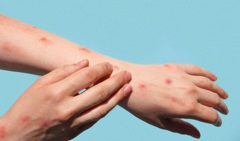 Setiap orang memiliki risiko penyakit herpes zoster, mulai dari anak-anak hingga dewasa. Oleh karena itu, upaya pencegahan penyakit herpes harus sejak dini dilakukan.