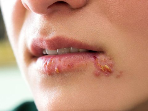 Cara Mengatasi Herpes Zoster