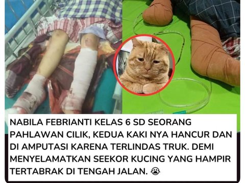 Kisah Viral Bocah Nabila Febrianti, Kaki Diamputasi Gara-Gara Selamatkan Kucing dari Kecelakaan