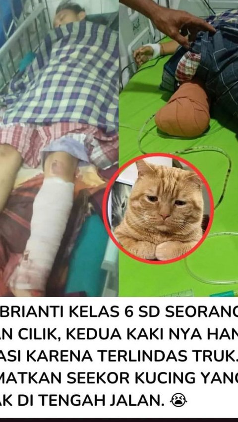 Kisah Viral Bocah Nabila Febrianti, Kaki Diamputasi Gara-Gara Selamatkan Kucing dari Kecelakaan