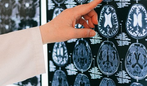 Stroke Hemoragik, Arteriovenous Malformation (AVM)