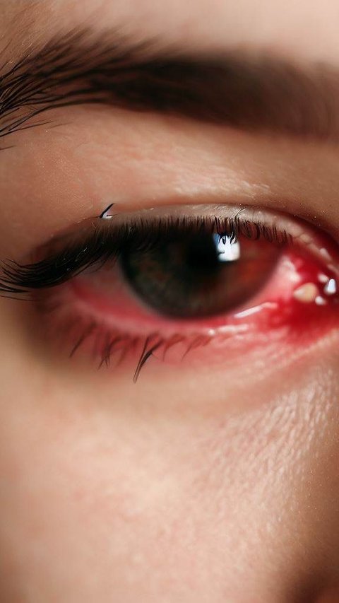 Meskipun beberapa kasus mata merah mungkin ringan dan tidak berbahaya, konsultasi dengan dokter mata adalah langkah penting untuk dilakukan.