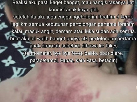 Viral Bayi Umur 13 Bulan Dikerok Babysitter, Ibunda Langsung Syok Lihat Kulit Anaknya