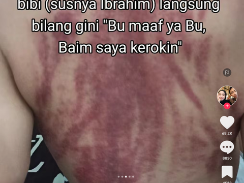 Viral Bayi Umur 13 Bulan Dikerok Babysitter, Ibunda Langsung Syok Lihat Kulit Anaknya