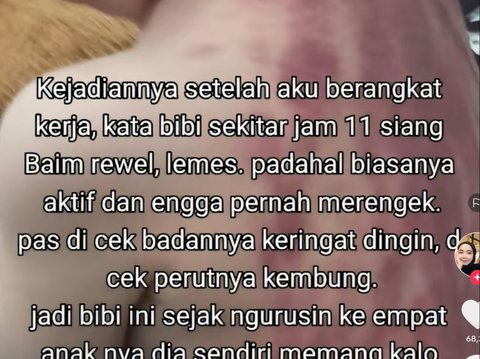 Viral Bayi Umur 13 Bulan Dikerok Babysitter, Ibunda Langsung Syok Lihat Kulit Anaknya