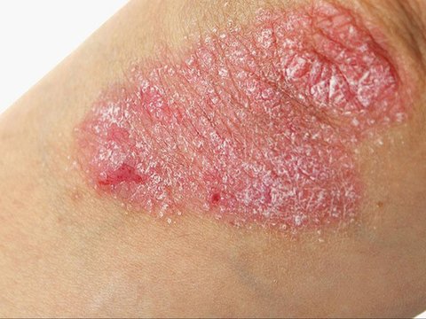 Metode Pengobatan Psoriasis Vulgaris