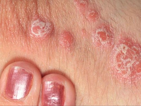 Pengertian Psoriasis Vulgaris