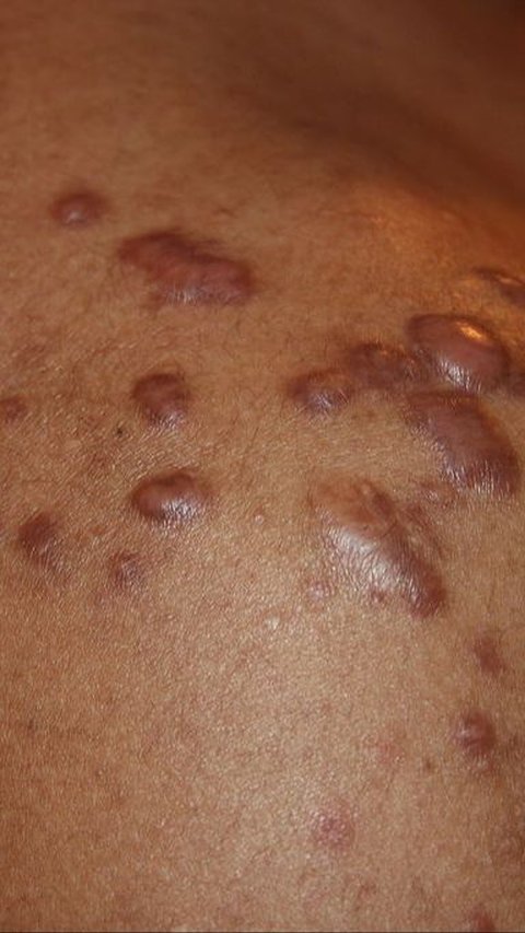 9 Cara Mudah dan Sederhana Obati Keloid di Rumah secara Mandiri