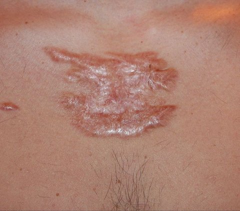 9 Cara Mudah dan Sederhana Obati Keloid di Rumah secara Mandiri