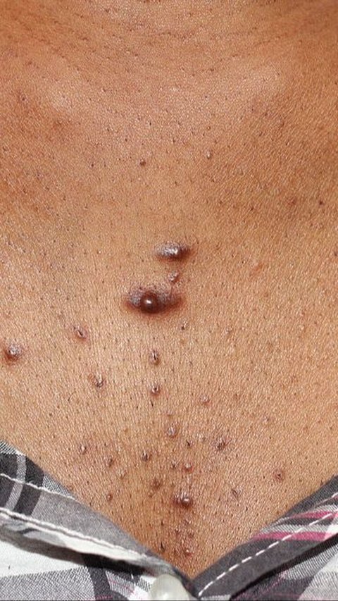 Perawatan mandiri mungkin tidak selalu menghilangkan keloid sepenuhnya, tetapi hanya bisa membantu mengurangi ukuran dan ketidaknyamanan.