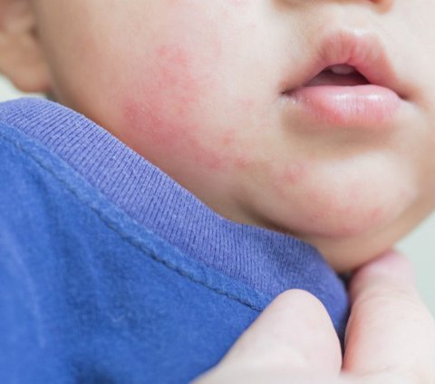 White Spots on a Child's Face is Not Always Tinea Versicolor, Could be Eczema