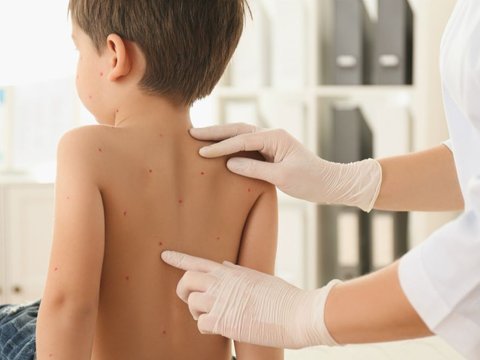 White Spots on a Child's Face is Not Always Tinea Versicolor, Could be Eczema
