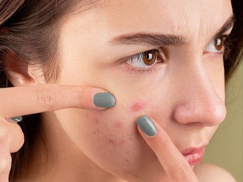 5 Steps to Reduce Acne-Causing Oil in the T-Zone