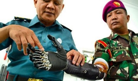 Untuk membantu aktivitasnya, Siswadi kemudian mendapat rehabilitasi berupa tangan robot atau tangan <i>bionic. </i><br>