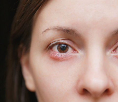 Mascara Causes Stye, Pay Attention to These Things