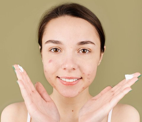 Teenage Acne Should Not Be Underestimated, Take Care to Avoid Scarring