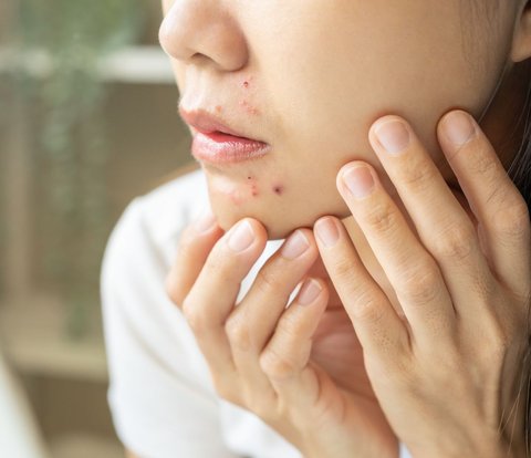 Teenage Acne Should Not Be Underestimated, Take Care to Avoid Scarring