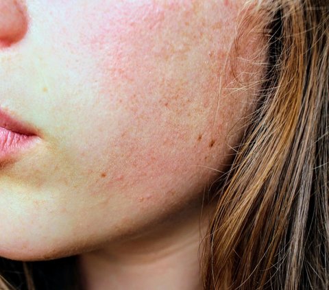 Dry Skin is also at high risk of acne, do the right treatment
