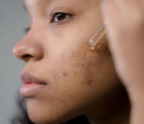 Acne Without Pus Makes Uncomfortable, Here's How to Overcome It