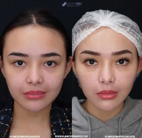 Potret perbandingan sebelum dan sesudah prosedur tarik benang di wajah Amanda Manopo menunjukkan perubahan yang signifikan.