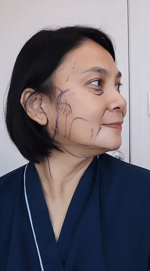 Potret Terbaru Dian Nitami Usai Sebulan Operasi Face Lifting, Hasilnya Natural Jadi Lebih Cantik & Awet Muda