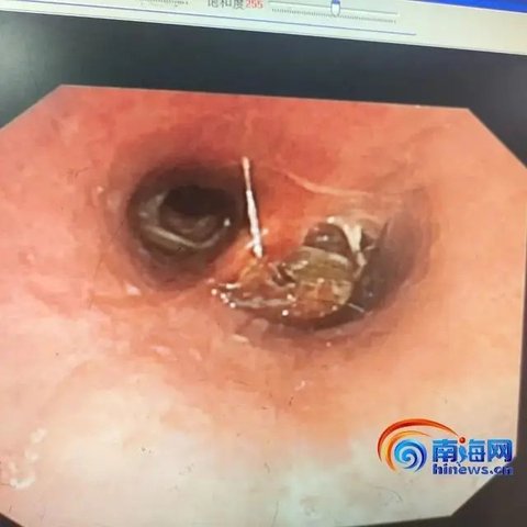 Saluran Napas Pria Ini Tersangkut Kecoa Mati (Ilustrasi Kecoa Pexels/Mart Production)