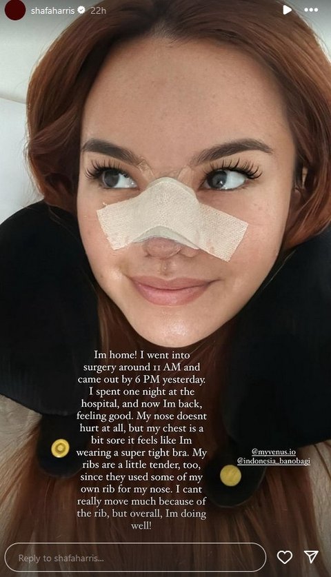 Potret Shafa Harris Oplas Hidung di Korea Selatan, Ambil Tulang dari Iga dan Wajah Minim Bengkak