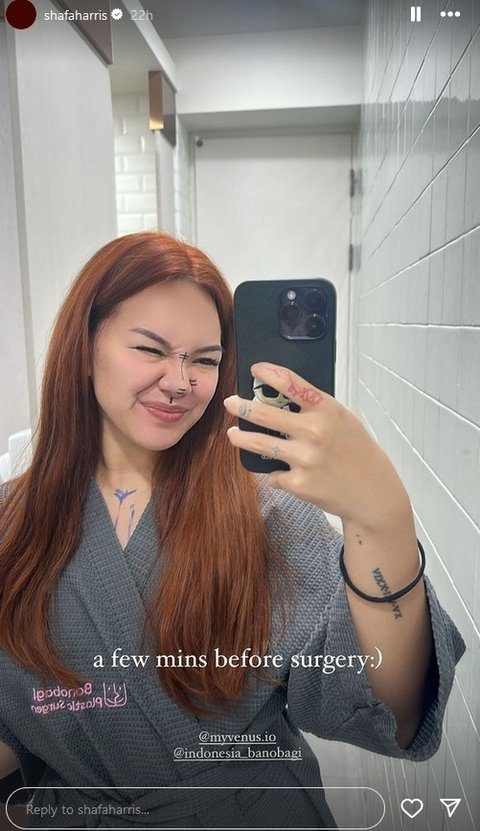 Potret Shafa Harris Oplas Hidung di Korea Selatan, Ambil Tulang dari Iga dan Wajah Minim Bengkak