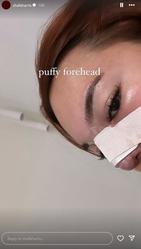 Potret Shafa Harris Oplas Hidung di Korea Selatan, Ambil Tulang dari Iga dan Wajah Minim Bengkak