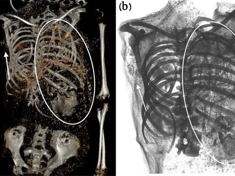 The Discovery of an Ancient Mummy Who Died During Childbirth, Baby's Head Still Trapped in the Pelvis