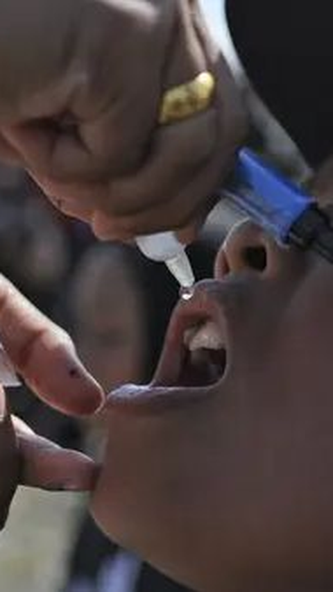 Kondisi Terkini Anak Kena Polio di Klaten