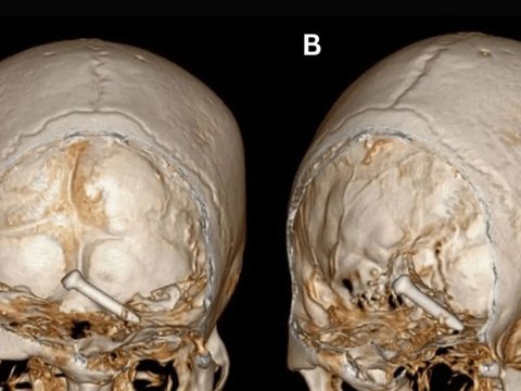 Horror! Worker Escapes Death After Nail Penetrates Eye and Brain