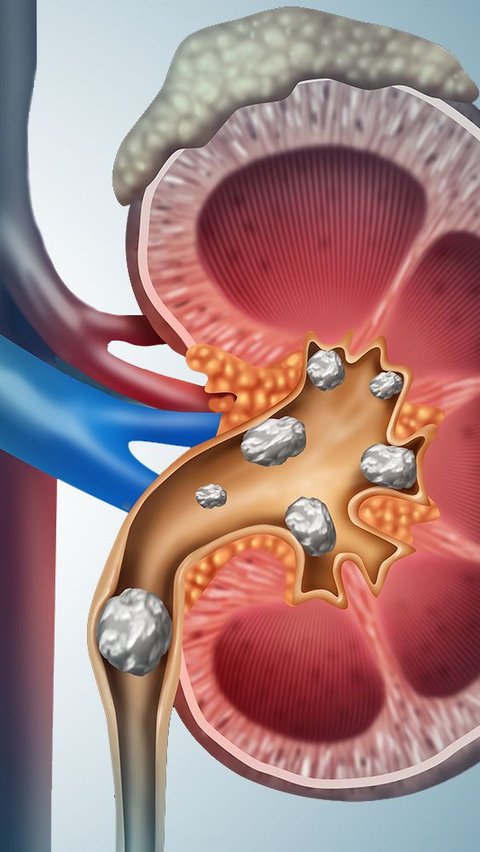 <b>Kebiasaan yang Sebabkan Batu Ginjal, Salah Satunya karena Kurang Minum</b>