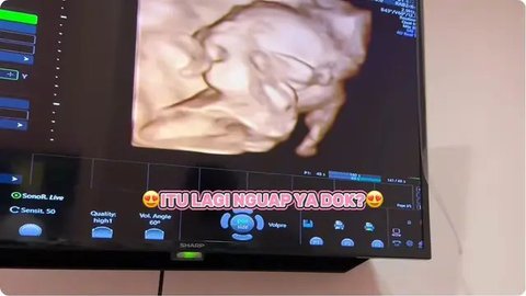 Shindy Putri periksa kandungan di kehamilan kedua ditemani suami. (sumber: YouTube/SHINDY TV)