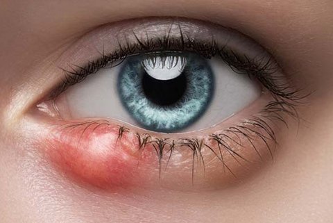 doa sakit mata bintitan