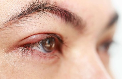 doa sakit mata bintitan