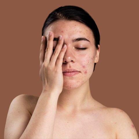 Cara Mencegah Jerawat