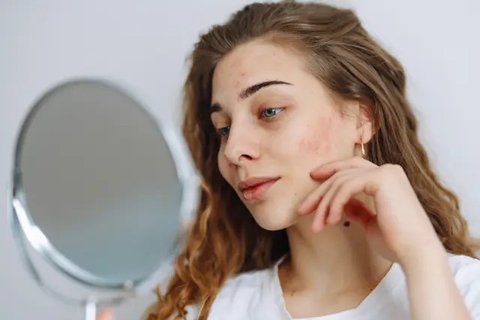 ilustrasi jerawat dagu/copyright pexels/Polina Tankilevitch