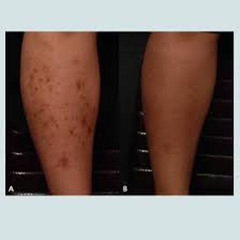 hiperpigmentasi pada kaki