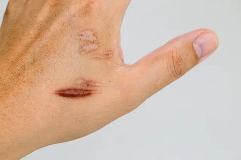 Keloid / Sumber: iStockphoto