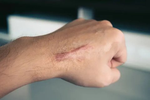 Keloid / Sumber: iStockphoto