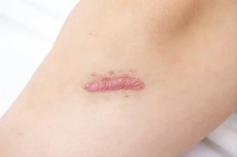 Keloid / Sumber: iStockphoto